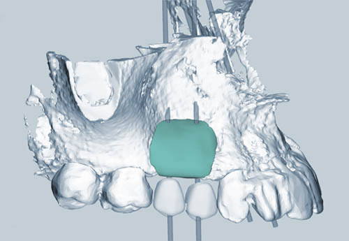 bone-regeneration