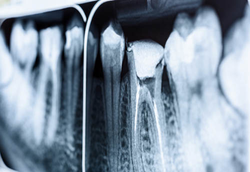 endodontics