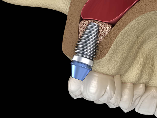advanced-bone-regeneration-precedure