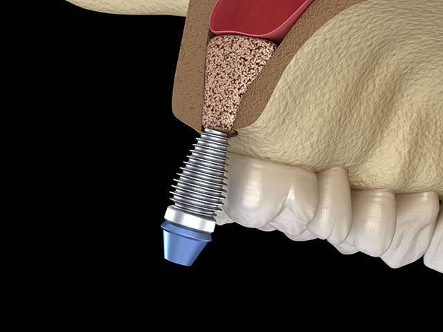 advanced-bone-regeneration-treatment-service