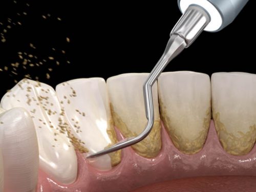 advanced-teeth-cleaning