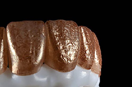 advanced-zirconia-crowns-croatia