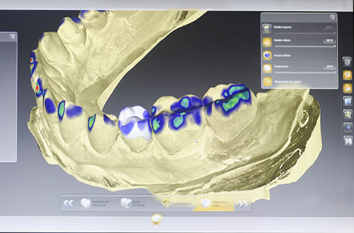 advanced-zirconia-crowns-london