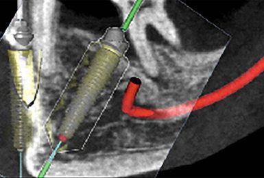 best-implant-installation-london