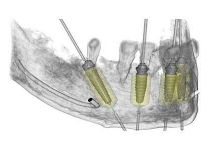 best-periodental-surgery