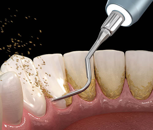 best-periodontal-surgery-harley-street