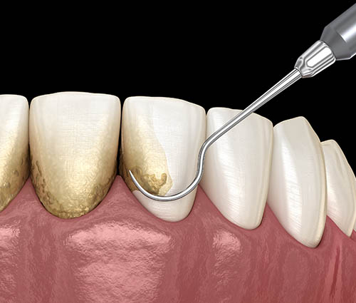 best-periodontal-surgery-opatija