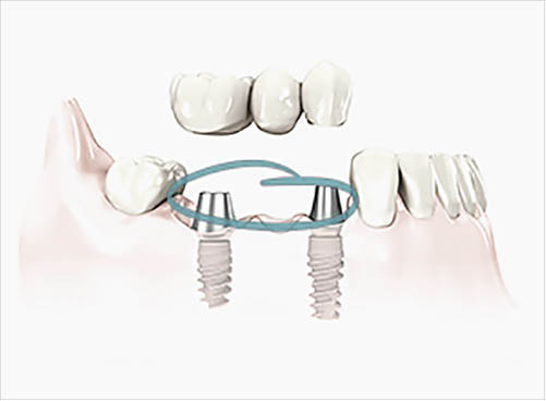 best-permanent-teeth-implants