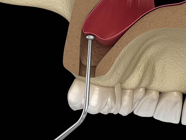 bone-regeneration-precedure-opatija