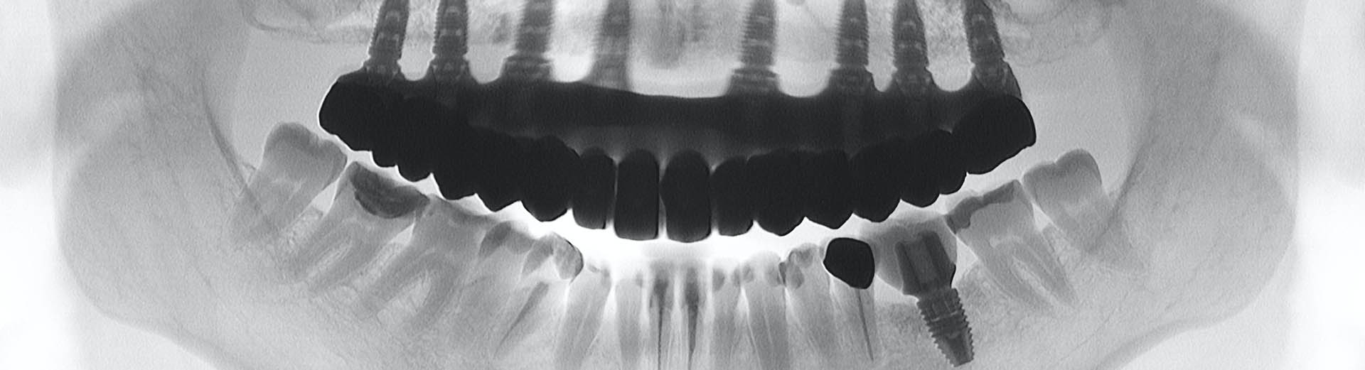 bone-regeneration