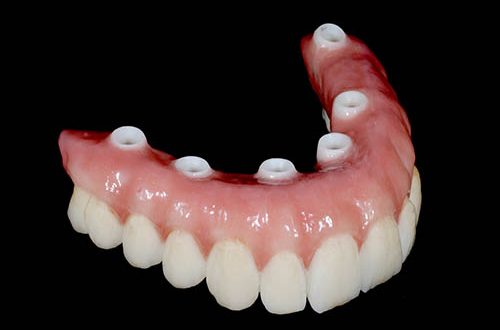 dental-bridges