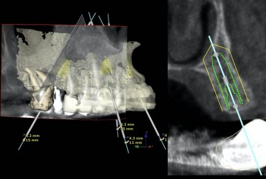 dental-implant-harley-street