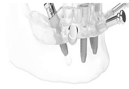 dental-implant-procedure
