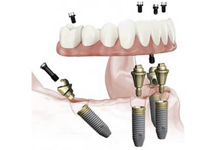 best-dental-implant-surgery-london