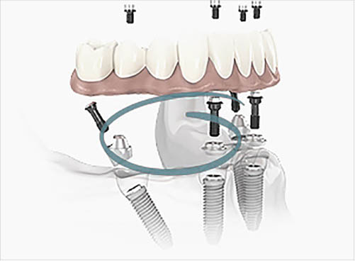 dental-implant-surgery