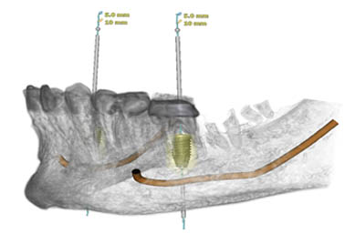 dental-implants-harley-street