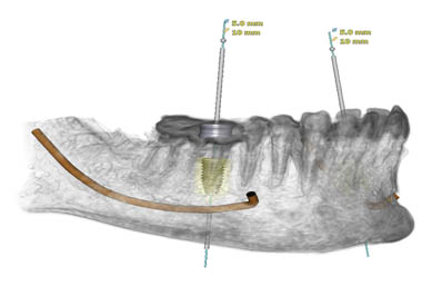 dental-implants
