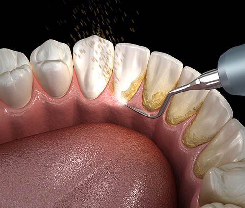 initial-periodontal-therapy-harley-street