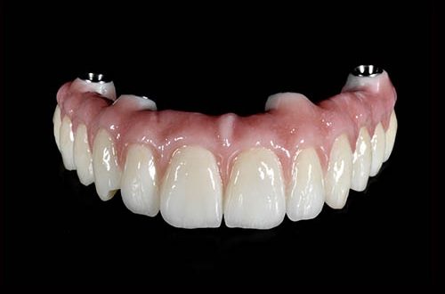 mobile-denture