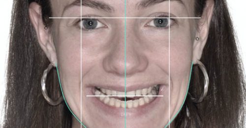perfect-smile