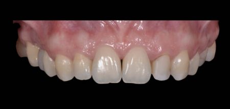 teeth-straighteing