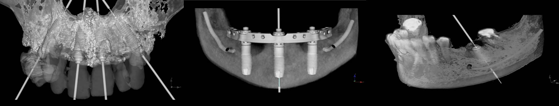 Implantology