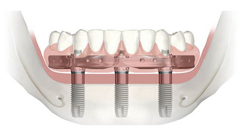 trefoil-implants