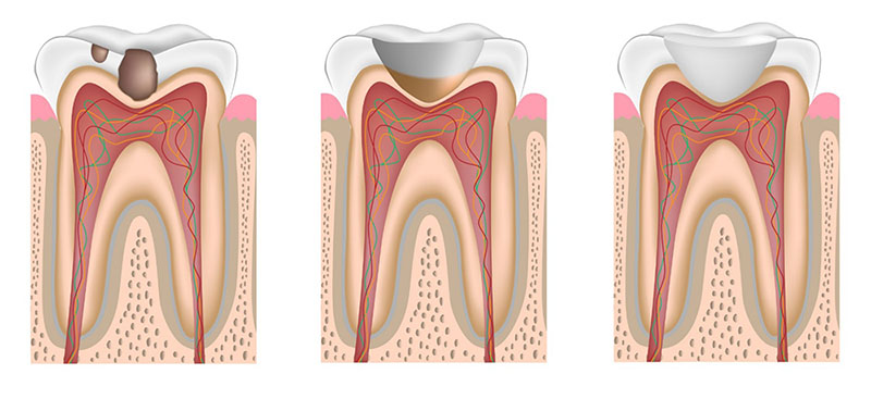dental-caries