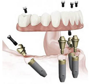 dental-implant-surgery