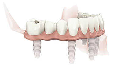 implant-treatments-for-edentulous-situations
