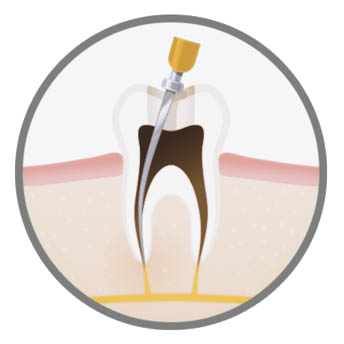 luxury-endodontic-treatment